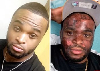 Neyo White, Atlanta, Chemical Peel, Diamond Facez Skincare Bar, Lawsuit, Burns, VIral, TikTok, Video.